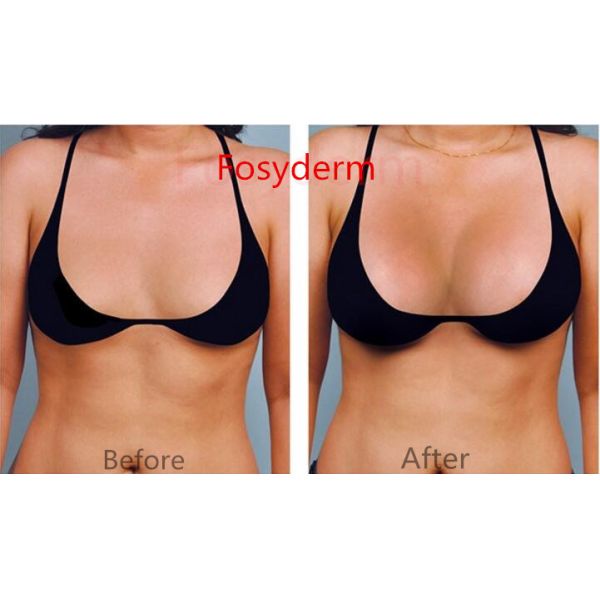 Заполнитель 10мл груди Хялуроник кислоты, заполнитель впрыски увеличения груди женщин