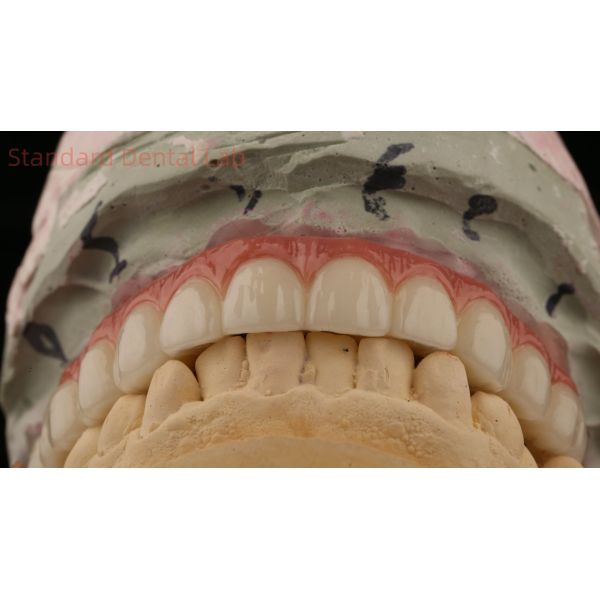 Hybrid Titanium Screw Retained Dental Implant Crown All On 4 Dental Implant Zirconia Bridge