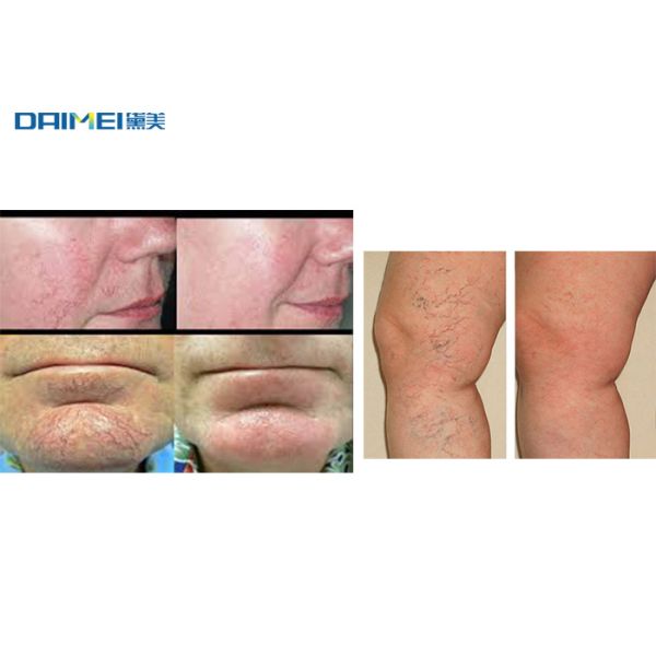 Vascular Removal Spider Vein Removal Machine 980nm Laser Touch Screen