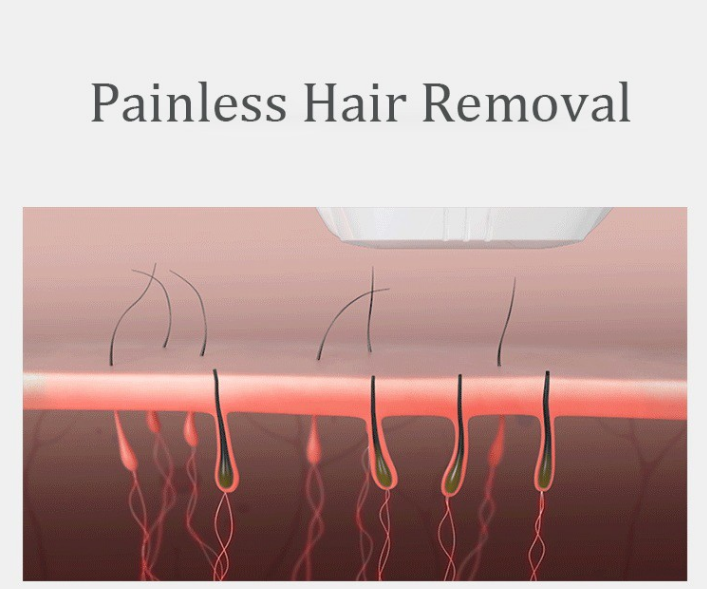 Salon IPL Laser Machine Strong Cooling System 1 - 10Hz Faster Scanning Treatment