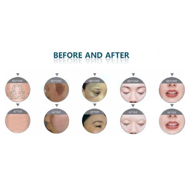 Elight SHR Hair Removal Machine , Portable Yag Laser Tattoo Removal Equipment