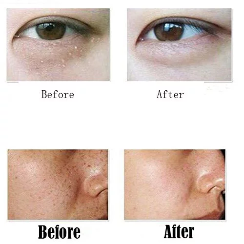 Facial Mole Removal Pen Freckle Tatoo Plasma Pen Skin Mole Removal Machine