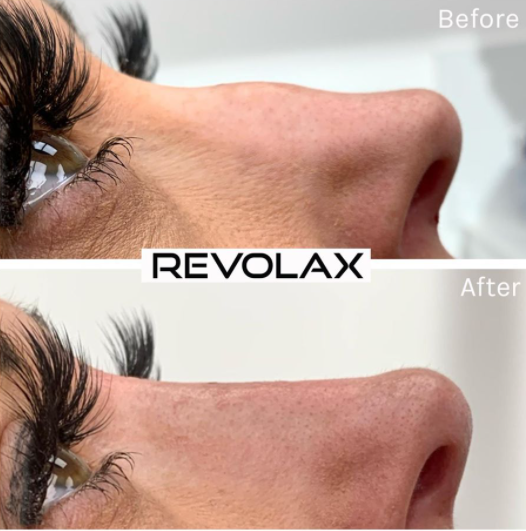 Revolax Acid Filler Injections With Lido Ha For Nasolabial Folds / Wrinkles