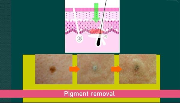 755nm Picosecond Laser Machine For Hair Removal / Tattoo Removal English Languages Option
