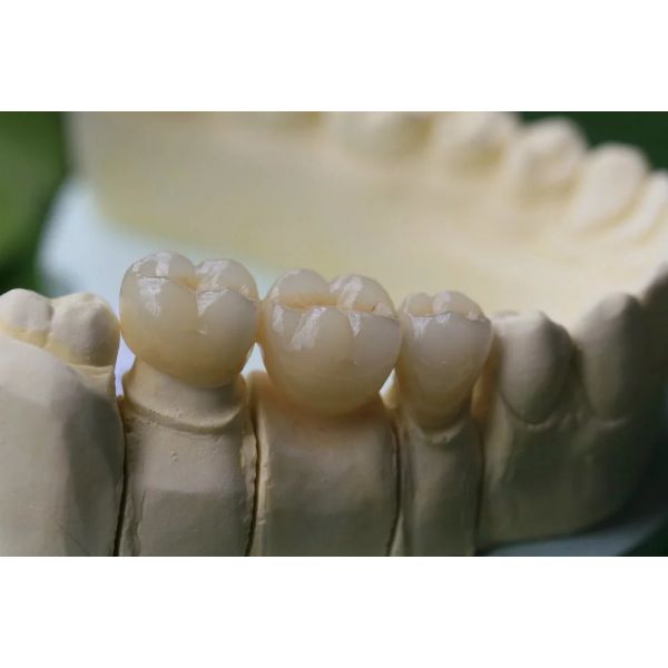 Dental Lab Fixed Prosthetics Layered Zirconia Dental Crown For Front Teeth