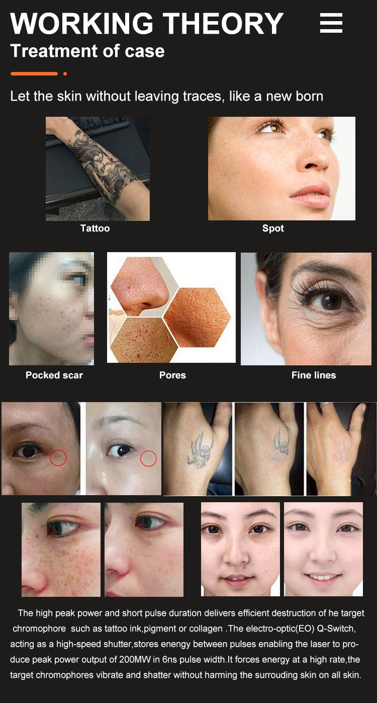 2023 Новая горячая продажа лазерная татуировка удаление Пико лазерная машина для продажи