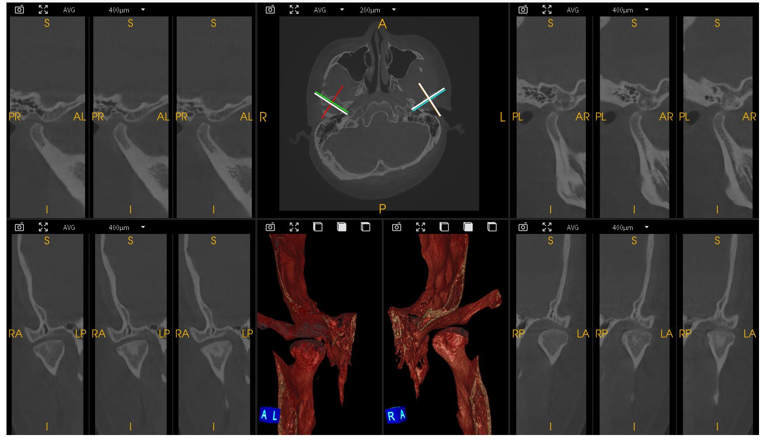 Dental Implant Orthodontic CBCT System High-Resolution 3D Imaging for Precise Diagnosis