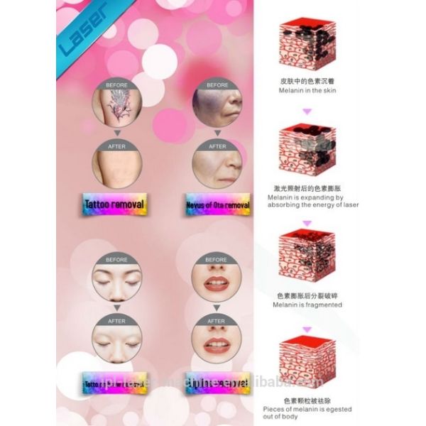 Discount price! Discount price! nd yag laser tattoo and nail fungus removal for tattoo removal, age pigment & freckle re