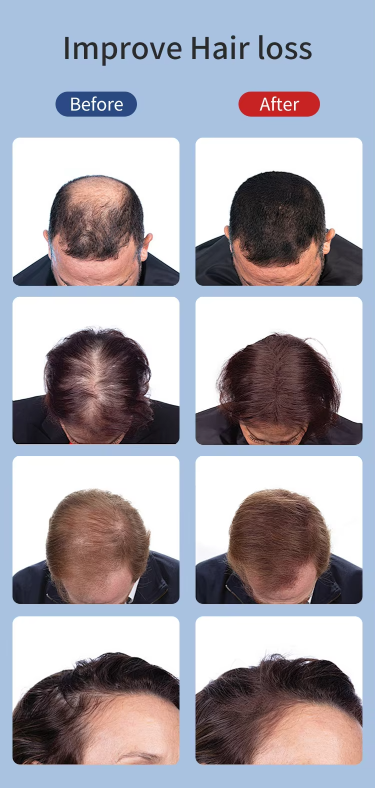 Advanced Laser anti-stripping hair cap Laser Hair Regrowth Therapy