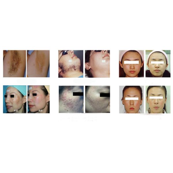 Professional Salon Beauty Equipment SHR IPL Laser Machine For Woman