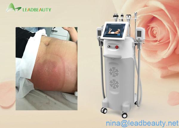 2016 most professional 5 heads Cryo/Ultrasound/RF heads cryolipolysis slimming machine