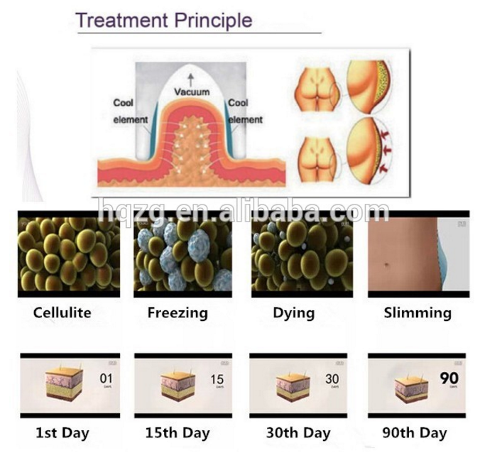 2 Head Cold Therapy Ultrasonic Cavitation Body Slimming Machine Fat Freeze Machine