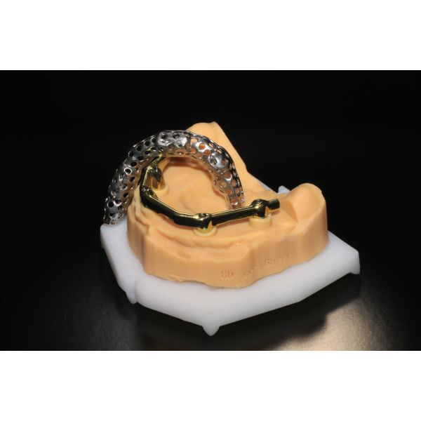 Gigital Dental Laboratory | Class 5 All On 4 AOX Implants With Hybrid Titanium Bar / Clips / Metal Mesh / Full Denture