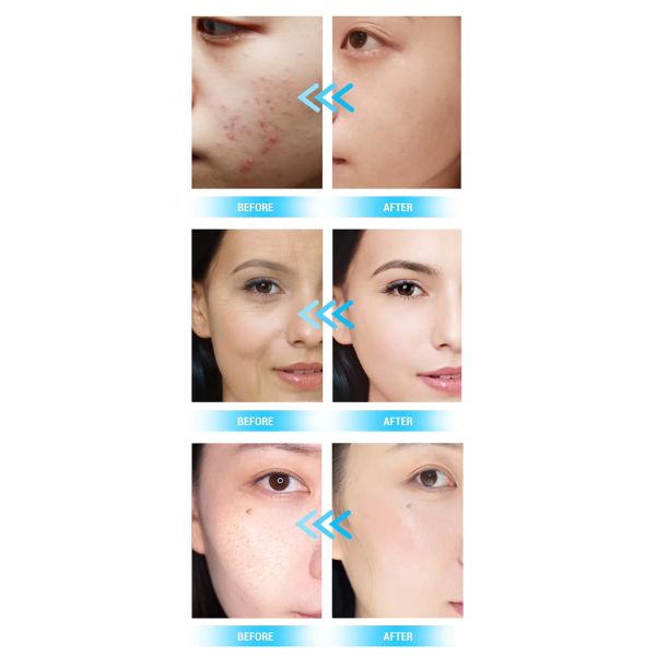 2024 Newest Visual Blackhead Removal Acne Removal Deep Facial Cleansing Skin Scrubber Hydra Beauty Machine