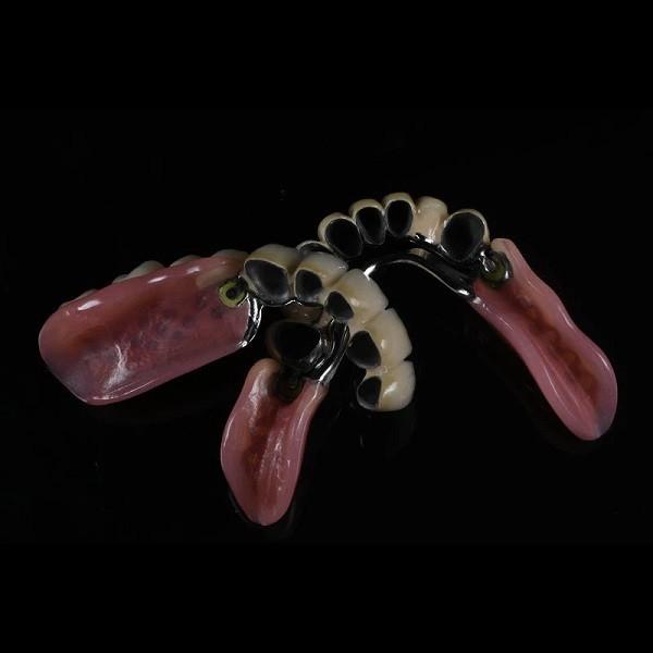 Aesthetic Precision Dental Implant Ball Attachment Partial Dentures