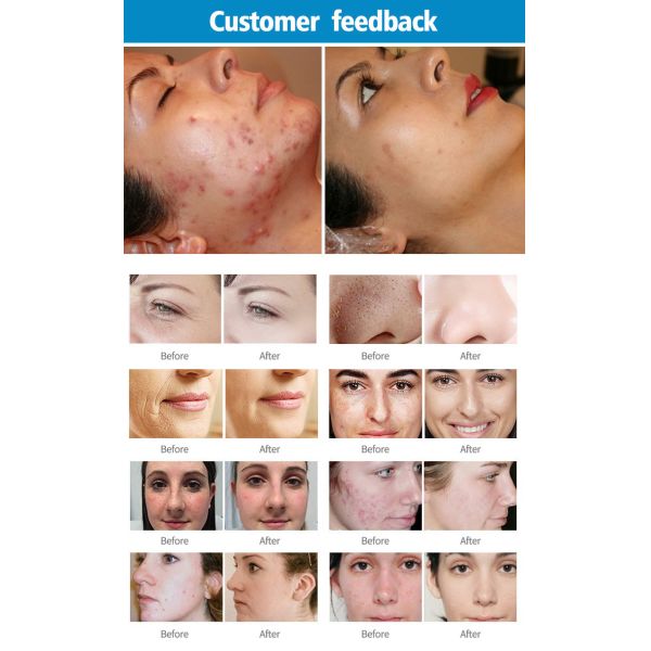 10600nm CO2 Fractional Laser Machine For Stretch Mark And Acne Scar Removal