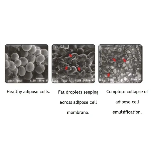лечение раны боли удаления живота машины липосакции лазера 10D жирное