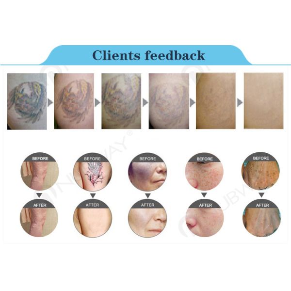 q-switch laser tattoo removal machine cheap laser tattoo removal machines
