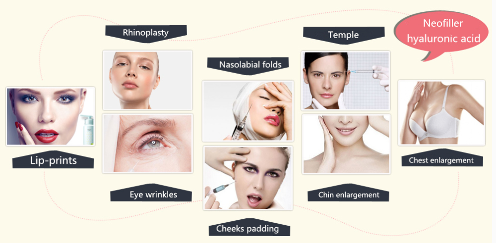 Сторона впрыски Ha наполнителя 1ml 2ml Derm Ha тонкой Derm глубокой Hyaluronic кислоты дермальная