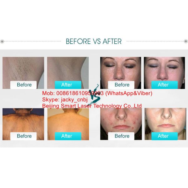 OPT SHR IPL Hair Removal Machine, Portable Elight IPL Beauty Machine