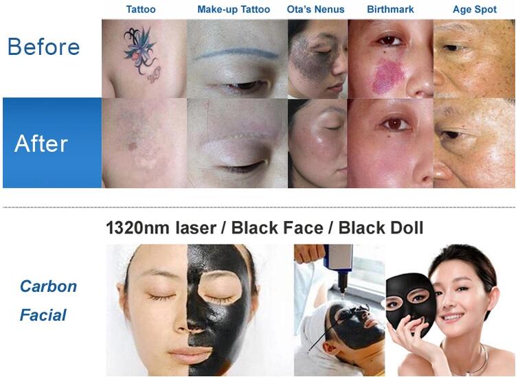 Портативное оборудование красоты шелушения углерода машины удаления татуировки лазера НД Яг портативное