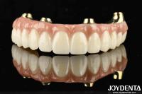 Fonctionnalité Le Ti-Bar compatible avec les dents et les gencives naturelles rétablit la fonction de mastication
