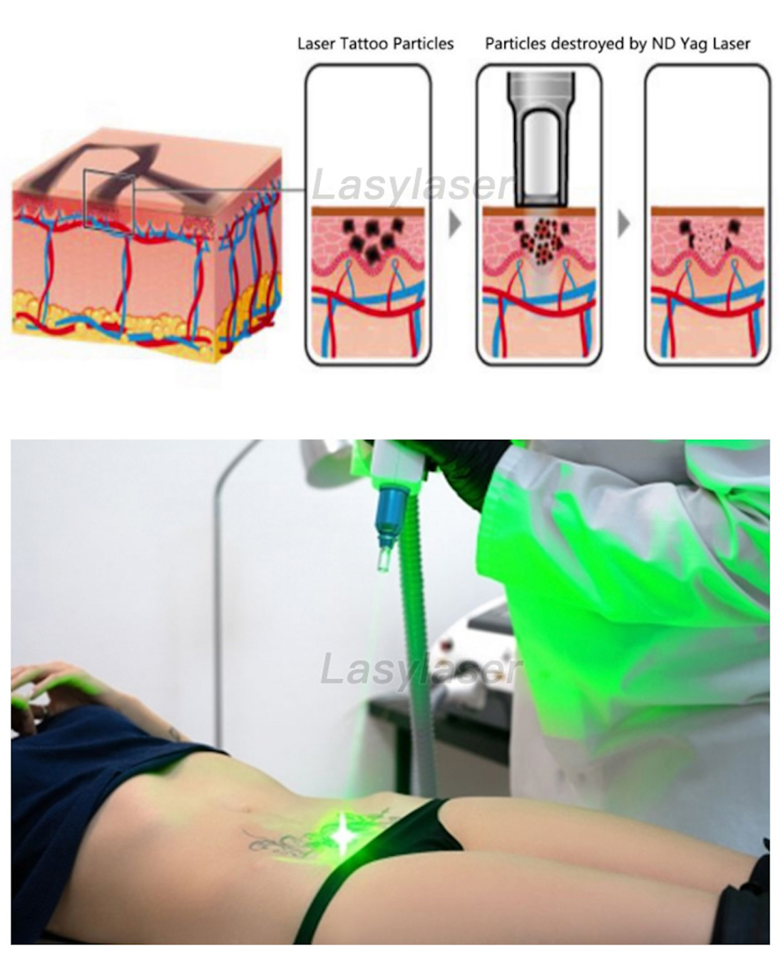 Nanosecond Portable ND YAG Laser Tattoo Removal Equipment 1064nm