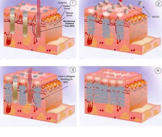 2020 professional Co2 Fractional Laser Machine Vaginal Tightening Beauty Equipment