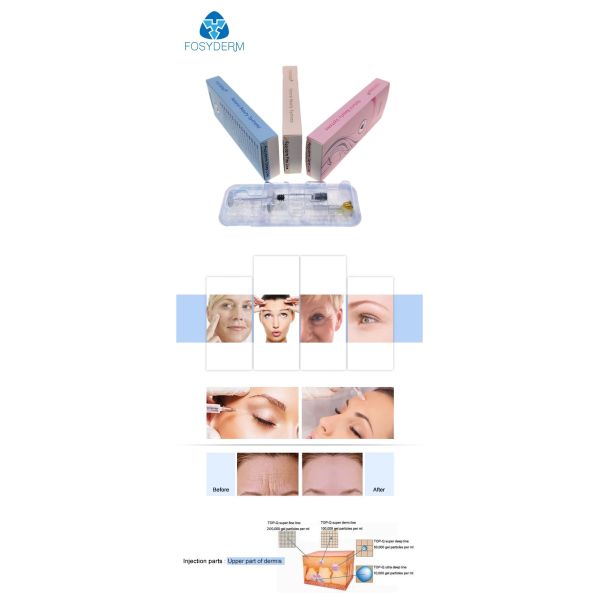 впрыска губы 1ml дермальных заполнителей 0.28mm HA Hyaluronic кисловочная