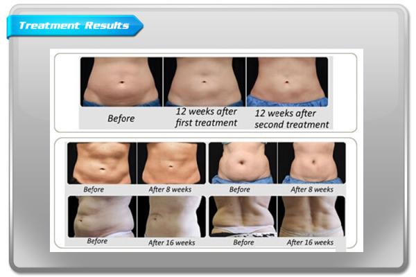 Super Cool System Cryolipolysis Cool Body Sculpting Fat Freezing Machine