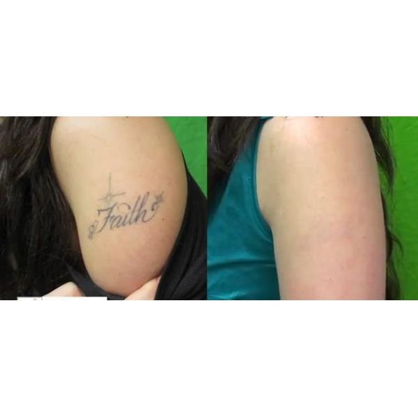 High Energy Picosecond Laser Tattoo Removal Machine 500000 Shots Long Life