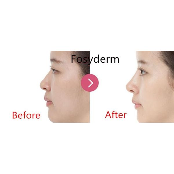 Fosyderm Hyaluronic Acid Injectable Filler 24mg Cosmetic Surgery Products
