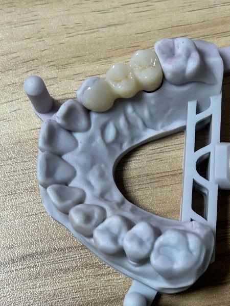 Maryland Bridge with CAD/CAM Digital Technology for Minimally Invasive Single Tooth Replacement Using Zirconia Material
