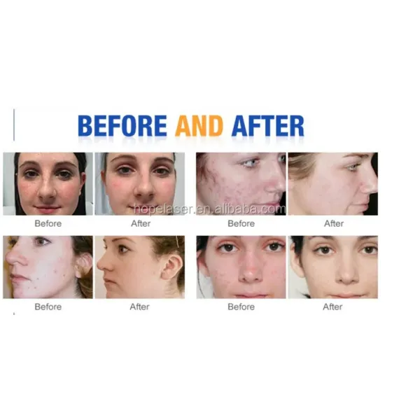 PDT photodynamic therapy and LED light therapy PDT beauty therapy for acne, wrinkle, relieve pain