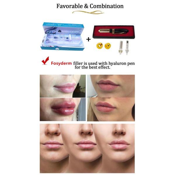 1.1ml Derm Dermal Lip Fillers Hyaluronic Acid Injectable Face Filler