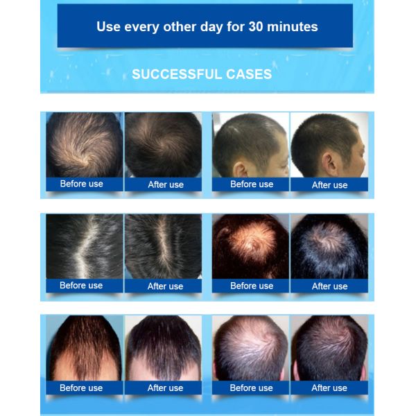 Lllt Laser Cap For Hair Regrowth