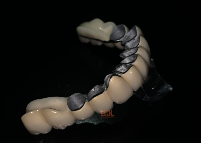 Custom Porcelain Fused To Metal Crown Designed To Provide Long Term Stability And Natural Look Ideal For Professional Dental