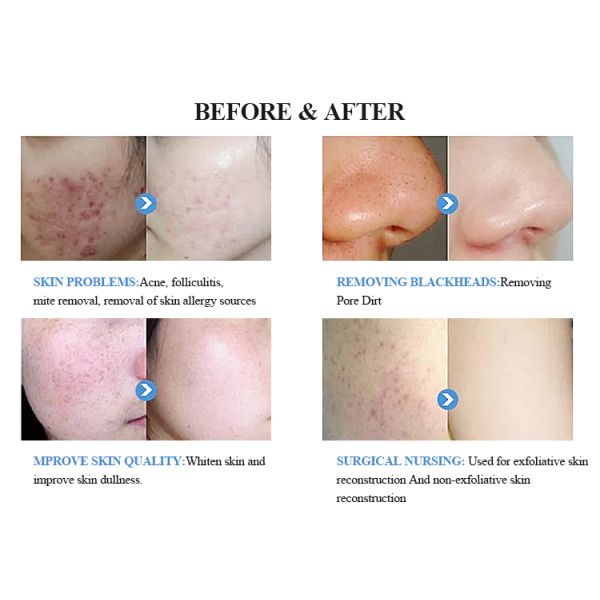 BIO RF Beauty Therapy Machine 15 Inch Cold Hammer Hydro Dermabrasion Device