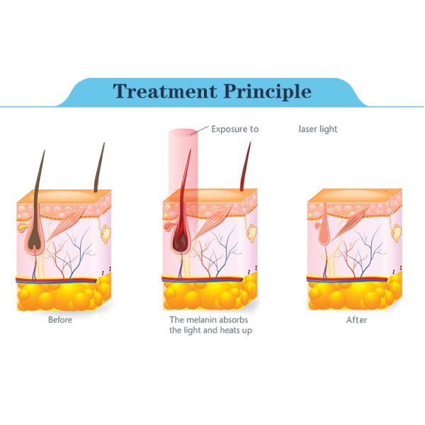 Nubway salon use beauty equipment 808 nm laser hair removal machine for spa