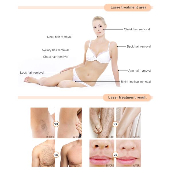 High Power 1600W Whitening Diode Laser Hair Removal Machine 3 Wavelength 755 808 1064