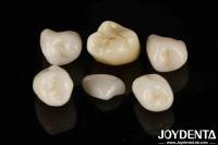 Fácil cementación Emax Inlay Onlay Fuerza media Estética de aspecto natural