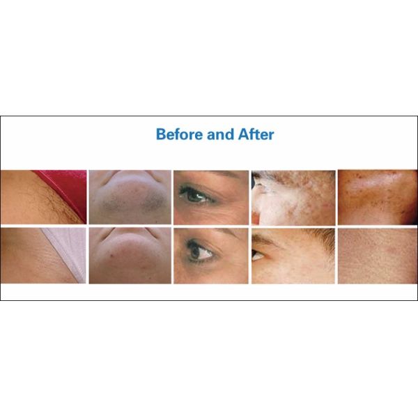 Multifunctional IPL Hair Removal Machine High Safety Without The Risk Of Injury