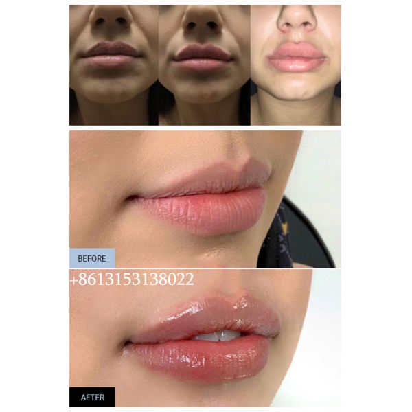 Впрыска лицевого заполнителя продолжительная Ultra3 Ultra4 Voluma Juvederm Hyaluronic кисловочная