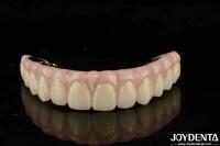 La résolution ultime pour la compatibilité des dents et des gencives naturelles