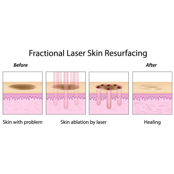 Serrage de la machine partielle de beauté de laser de CO2 de peau pour le retrait de cicatrice de colorant d'acné