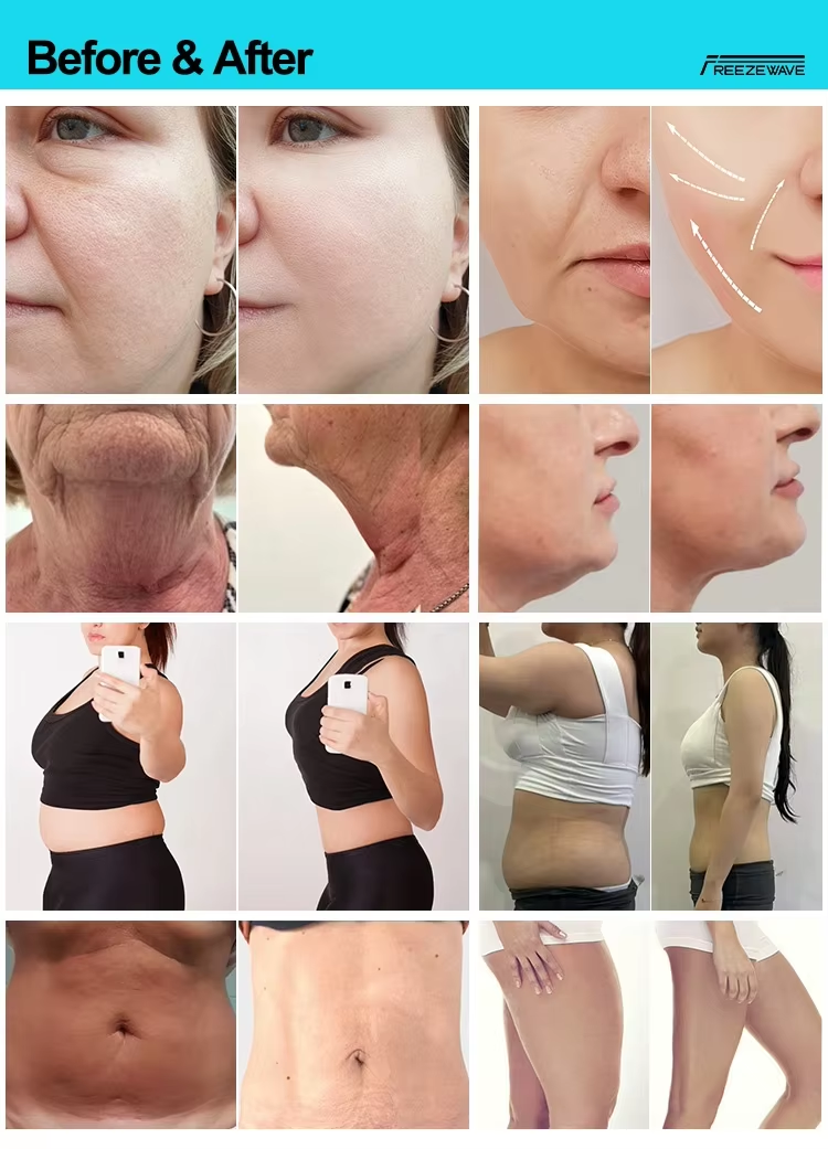 3 Handle 2.45GHz Onda PRO Coolwave Cellulite Removal Weight Loss Standing Body Slimming Machine