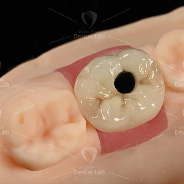 PFM Dental Implant Bridge Co-Cr Screw Retained Bridge CAD CAM Designed