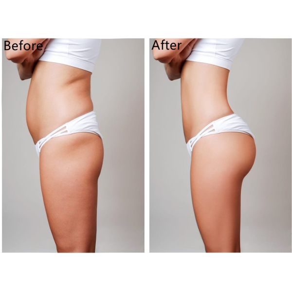 Hyaluronic Acid Breast Dermal Filler Breast Augmentation Buttock Lift Injection