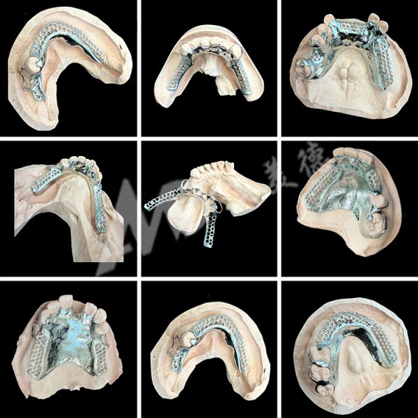 Easy Fit Custom Cast Partial Denture Stable and Natural-looking Framework for Fast Results