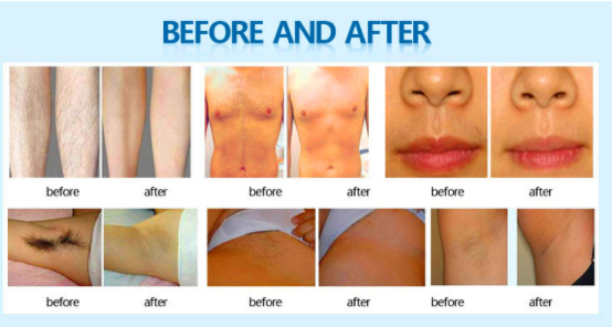 ISO 13485 IPL Hair Removal Device OPT SHR Skin Rejuvenation Machine